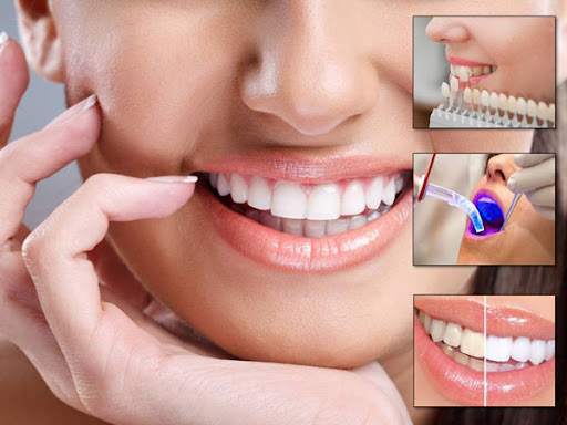 مراقبت های بعد از درمان زیبایی دندان