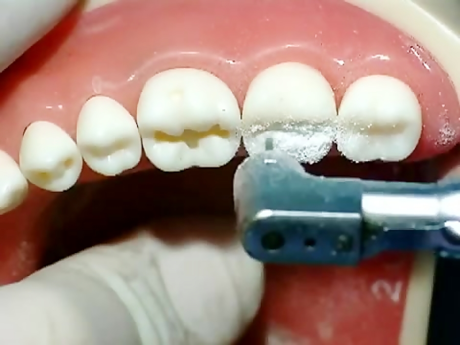 انواع دایکال دندانپزشکی