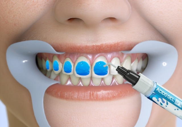 استفاده از باندینگ دندان برای چه مواقعی است؟