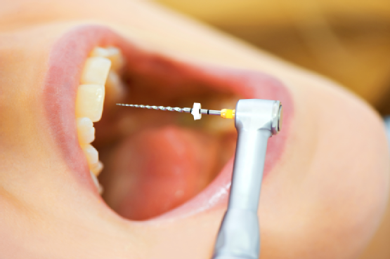 گوتا پرکا در عصب کشی دندان به چه معنا می باشد؟
