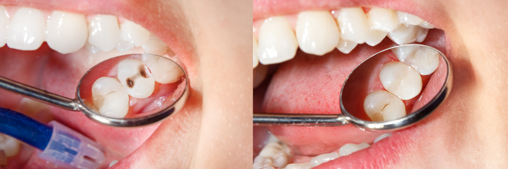 از چه موادی برای پر کردن دندان استفاده می شود؟