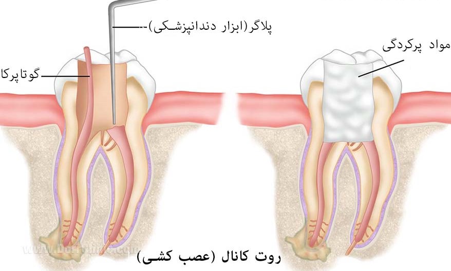 روش گوتا پرکا با استفاده از پلاگر دندانپزشکی