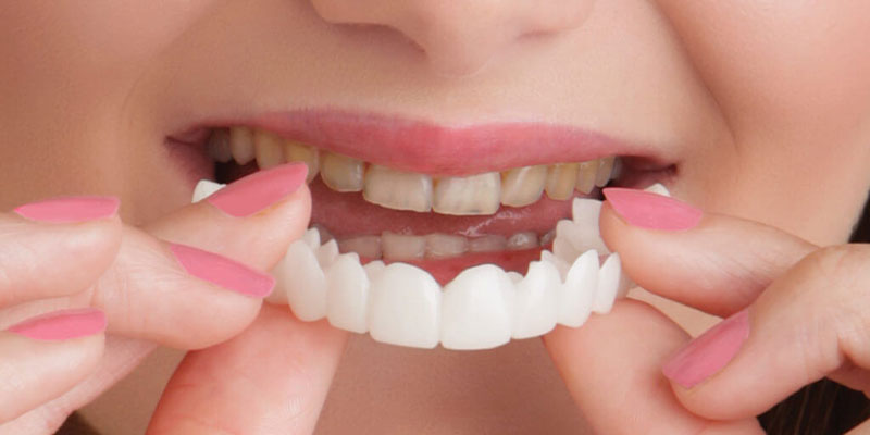 مزیت های استفاده از کامپوزیت دندان