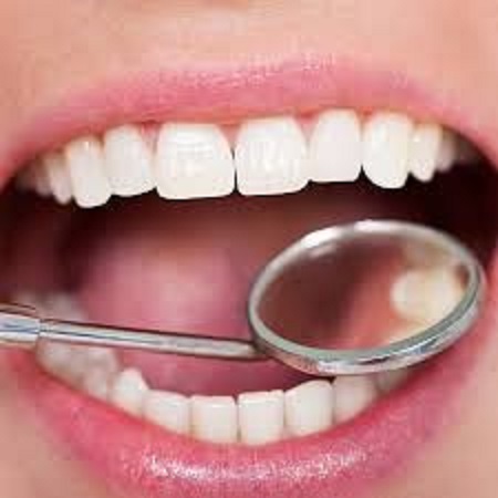 بعد از پر کردن دندان به موارد زیر توجه کنید: