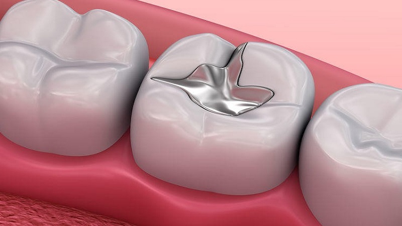 پرکردن دندان با مواد همرنگ 1