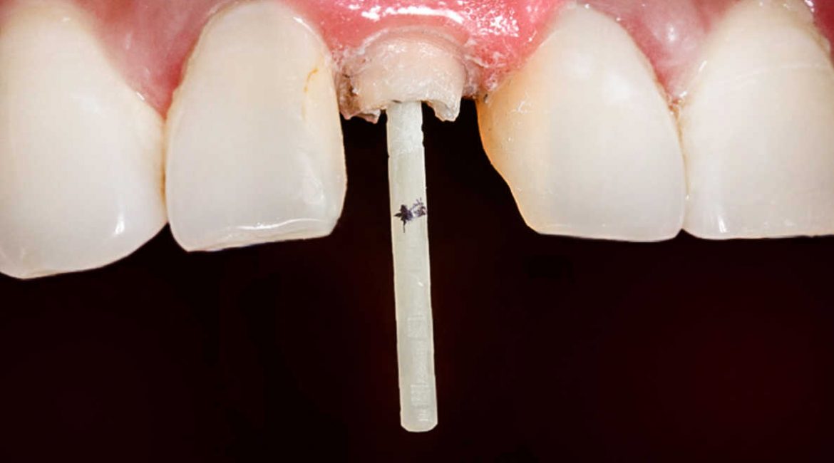 انواع فایبر پست دندان