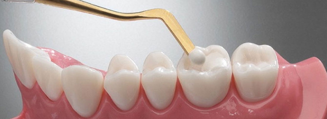 ویژگی های خمیر پرکردن دندان