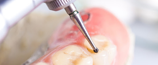 نکات مهم در نگهداری فرز های دندانپزشکی