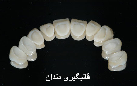 قالب گیری دندان چیست؟
