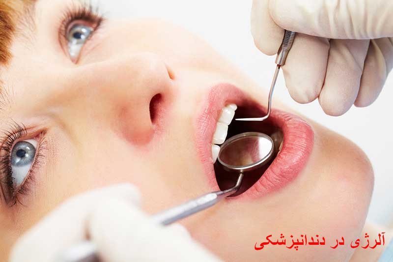موارد موجود در دندانپزشکی که باعث آلرژی می شود