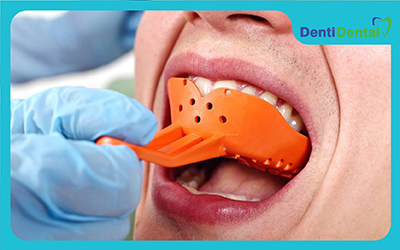 قالب دندانپزشکی