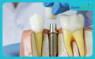 تفاوت میان انواع ایمپلنت دندان