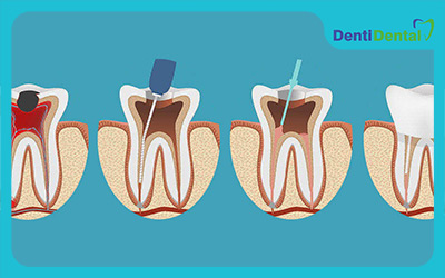 Endodontic-steps
