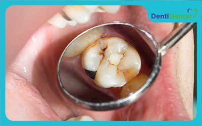 مواد ترمیم دندان چیست