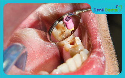 What is endodontics