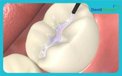 انواع سیلر دندانپزشکی