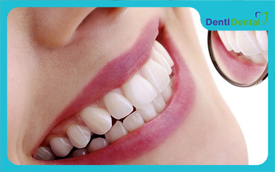 مزایا و معایب لاک سفید کننده دندان