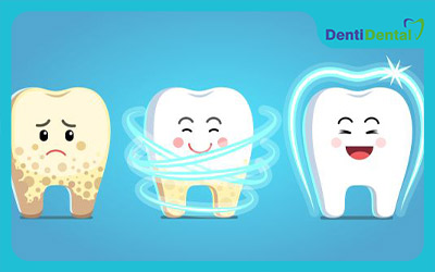 معرفی مواد سفیدکننده دندان