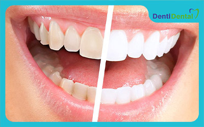 انواع مواد سفید کننده دندان