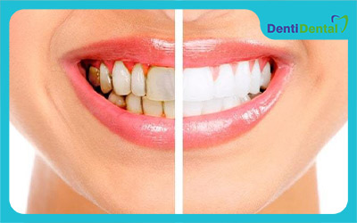 روش های مختلف سفید کردن دندان