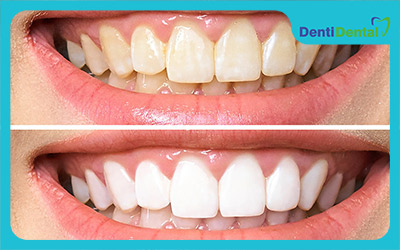 سفید کننده دندان چیست