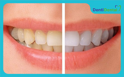 بهترین برند کامپوزیت دندان چه ویژگی‌هایی دارد؟