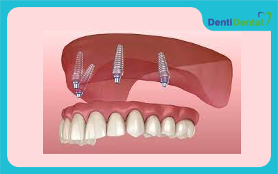 انواع دندان مصنوعی ثابت