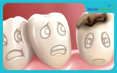 علائم پوسدگی دندان