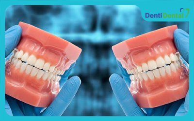کاربرد مواد قالب گیری دندان