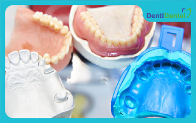 dental molding materials