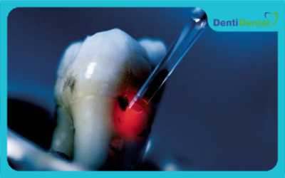 عوارض لیز در دندانپزشکی